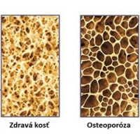 Zaujalo nás. Osteoporóza je skorbut kostí, nie nedostatok vápnika!